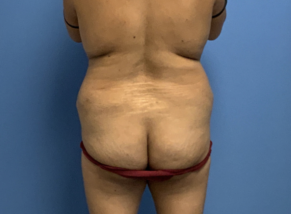 Brazilian-Butt-Lift--Case-Study-3682 | Before Body